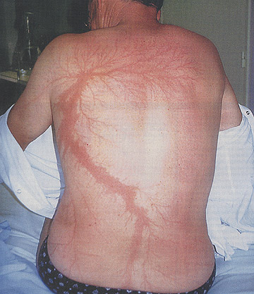 Check this out! The scars on this unlucky victim's back are a permanent record of lightning's deadly power.